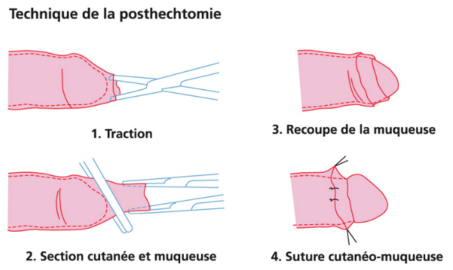 Plusieurs cas de circoncisions ratées