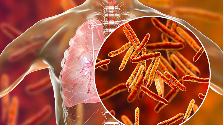 La tuberculose bien présente à Mayotte