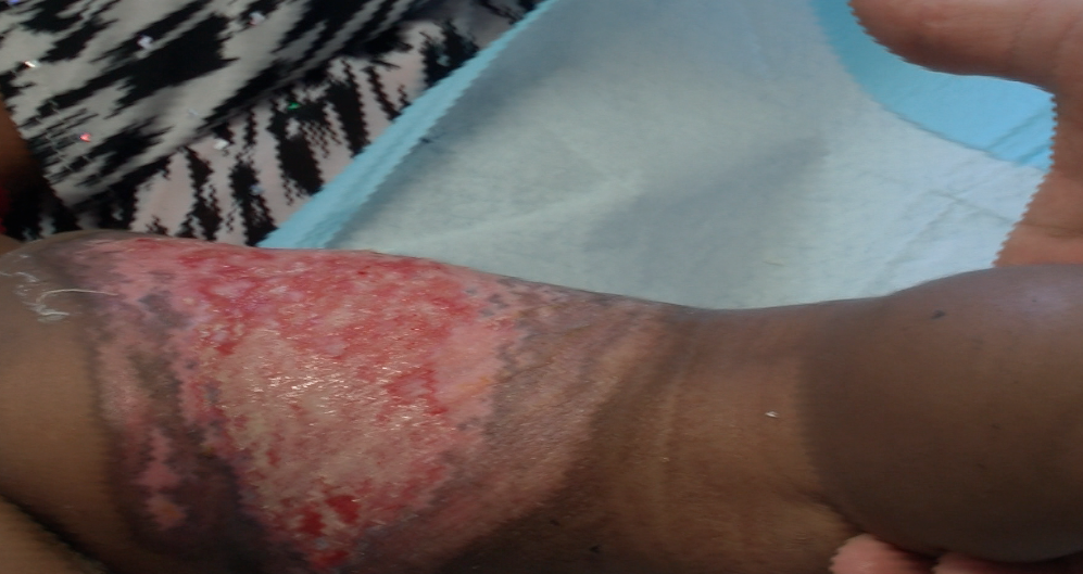 Ramadan : attention aux brûlures (vidéo)