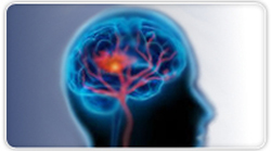 Journée mondiale de l’AVC le 29 octobre