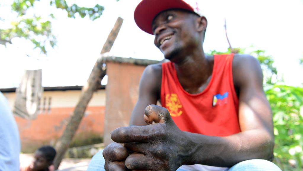 Journée mondiale de lutte contre la lèpre