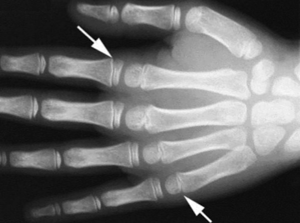 Les dispositions légales relatives aux tests osseux ont changé