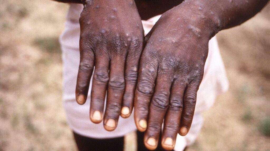Un kwassa sanitaire potentiellement à risques 1 variole du singe monkeypox 8bd58c 0@1x