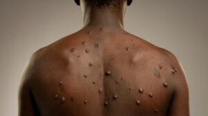 Mpox à Mayotte, variole du singe, surveillance sanitaire ARS