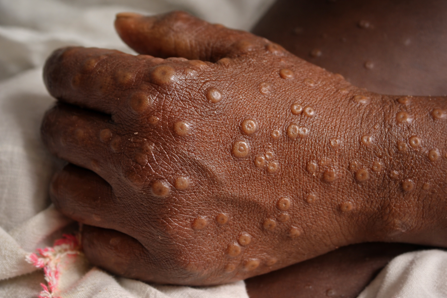Un nouveau cas de Mpox à Mayotte