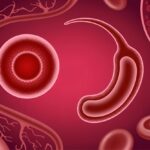 Accueil 8 Drépanocytose : 4 % des Mahorais concernés