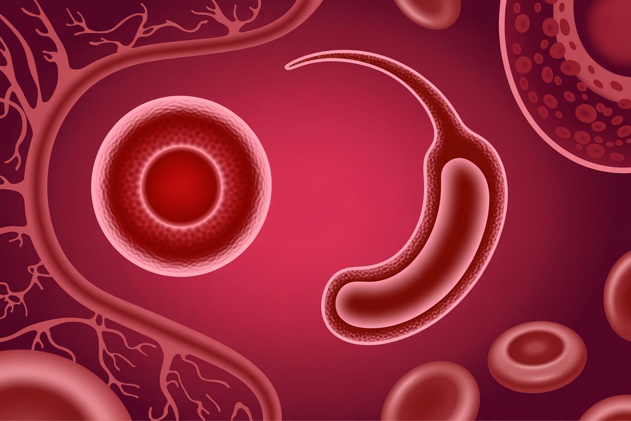 Drépanocytose : 4 % des Mahorais concernés