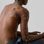 Accueil 3 Un nouveau cas de Mpox importé, vigilance maintenue et...