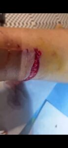 Joggeur blessé après avoir été attaqué et mordu par plusieurs chiens lors d’un footing à Koungou à Mayotte.