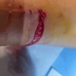 Un joggeur attaqué par plusieurs chiens à Koungou