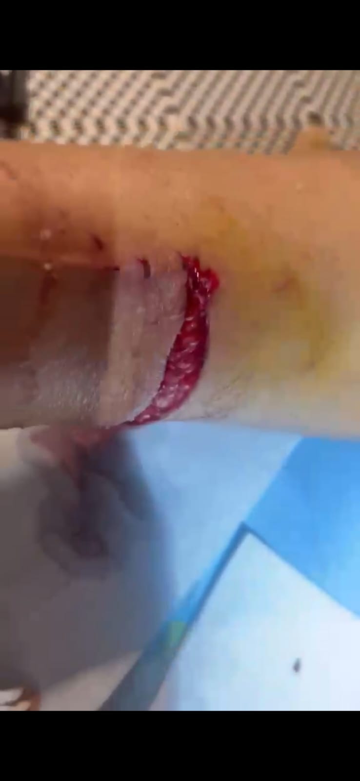 Un joggeur attaqué par plusieurs chiens à Koungou